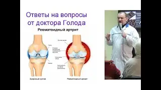 Ревматоидный артрит – ответ доктора Голода