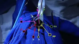 Wendler Glottoplasty: transgender voice feminization surgery