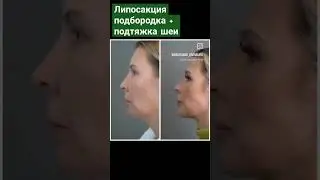 Липосакция подбородка и подтяжка шеи (неклифт) #убратьподбородок #медгард_оренбург #медицина #shorts