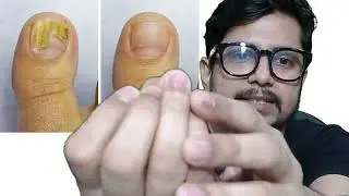 Nail fungus treatment | Nail fungus infection | nakhun me fungal infection