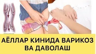 ВАРИКОЗ! АЁЛЛАР ЖИНСИЙ АЪЗОСИДА!