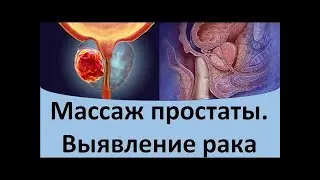 Как можно самому сделать массаж простаты: правила, техники. 