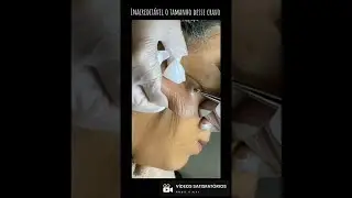 Removing Giant Blackhead | Unbelievable!!! 😱😰